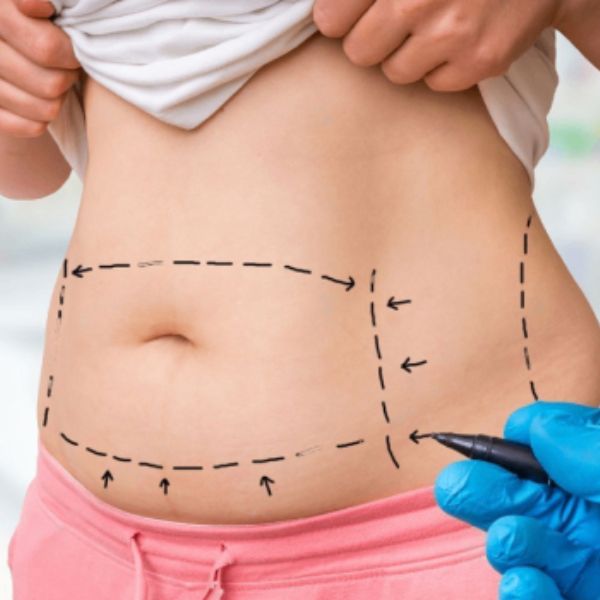 Abdominoplasty