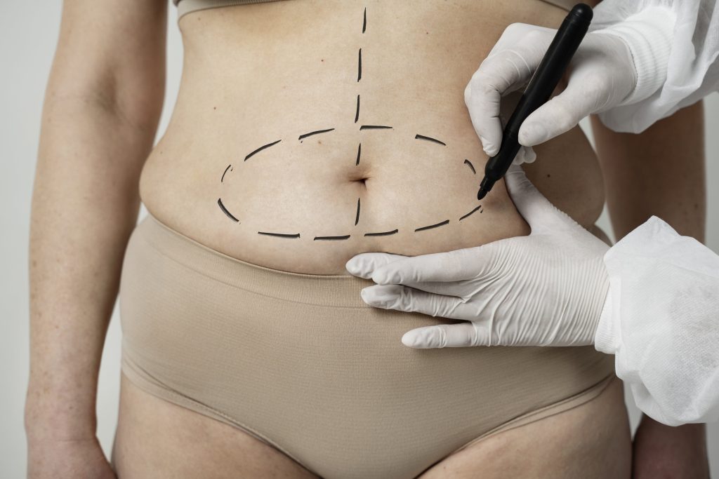 Liposuction Surgery in Indore