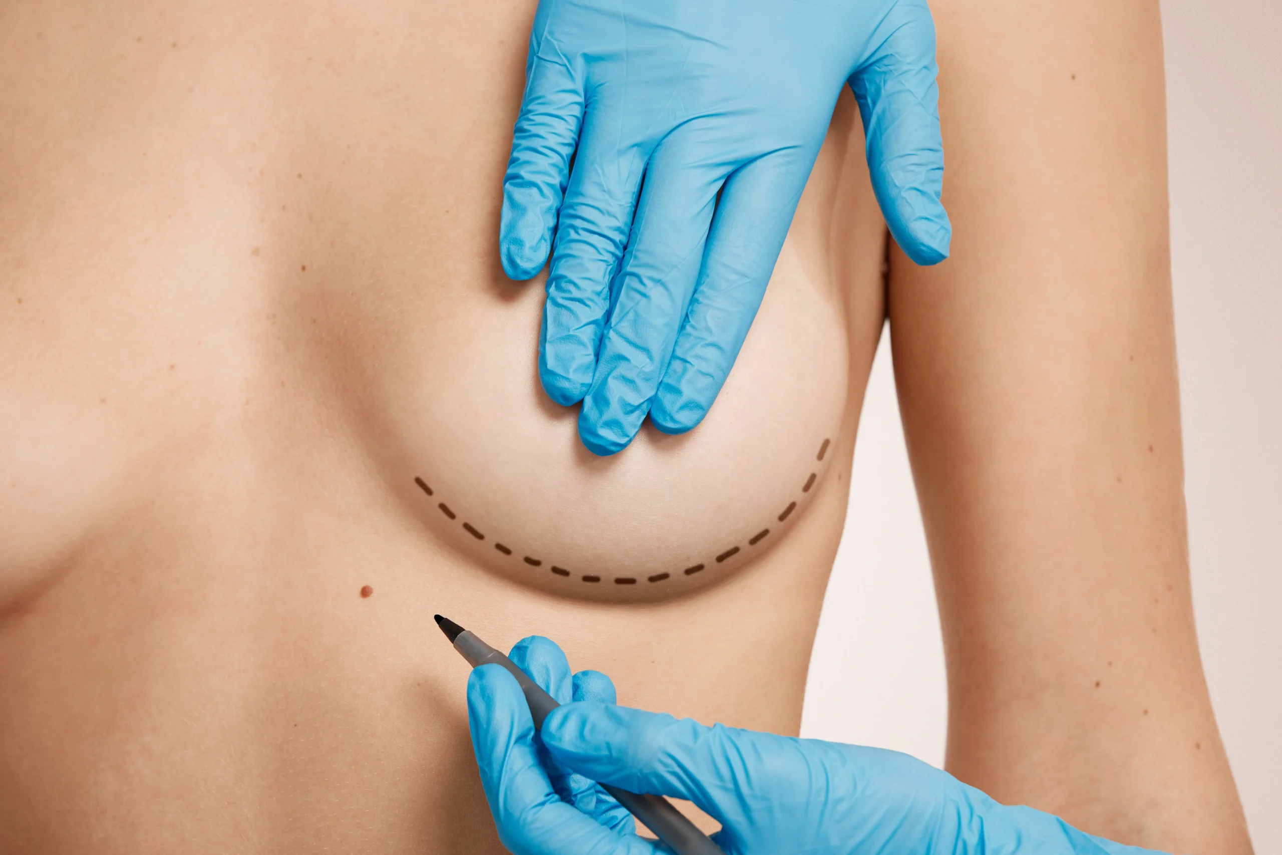 Is Breast Reduction Right for You? Top Benefits Every Woman Should Know